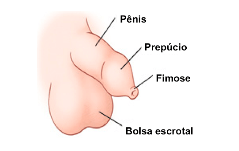 Fimose